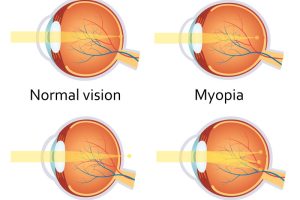 Refractive Errors Image