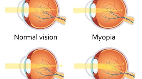 Refractive Errors Image