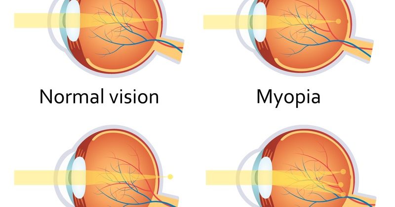 Refractive Errors Image
