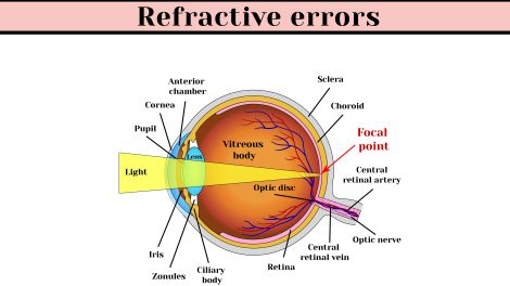 Type of refractive error featured image