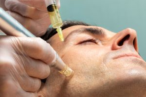 Microneedling Acne Scars