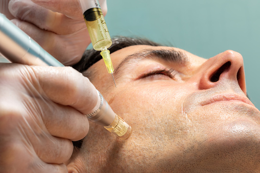 Microneedling Acne Scars