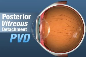 Posterior Vitreous Detachment featured image