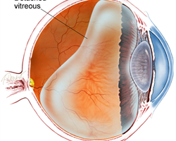 Posterior Vitreous Detachment Image