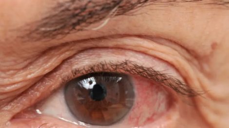 dry eyes featured image