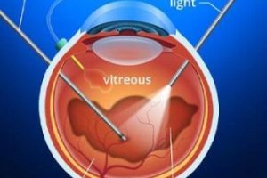 Vitrectomy - Featured Image