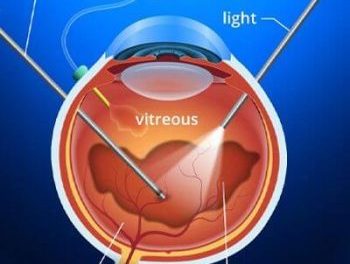 Vitrectomy - Featured Image