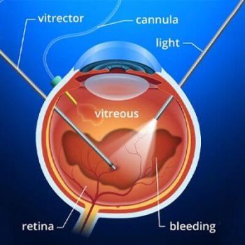 Vitrectomy - Featured Image