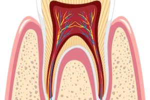 root canal therapy