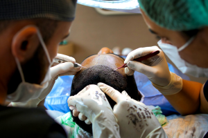 زراعة الشعر