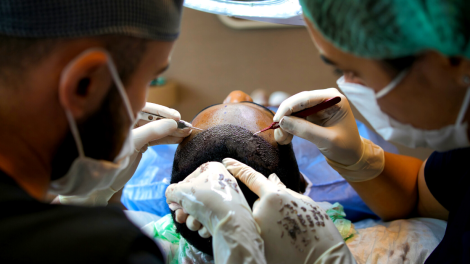 زراعة الشعر
